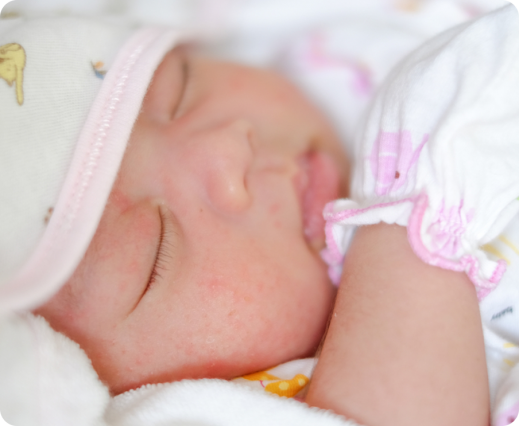 Trądzik niemowlęcy - czym jest i jak sobie radzić?